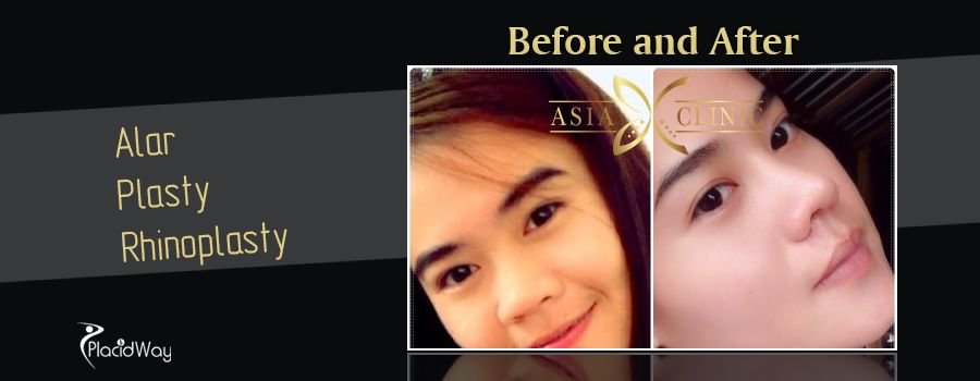 Before and After Images Nose Surgery Thailand